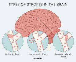 Neurology - Pawana Speciality Clinic